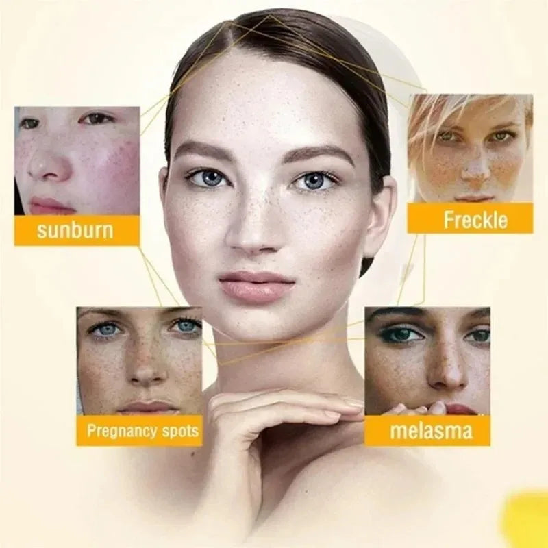 Whitening Freckle Cream Remove Dark Spots Anti Freckle Face Creams Niacinamide Fade Pigmentation Melasma Brighten Skin Care 20g