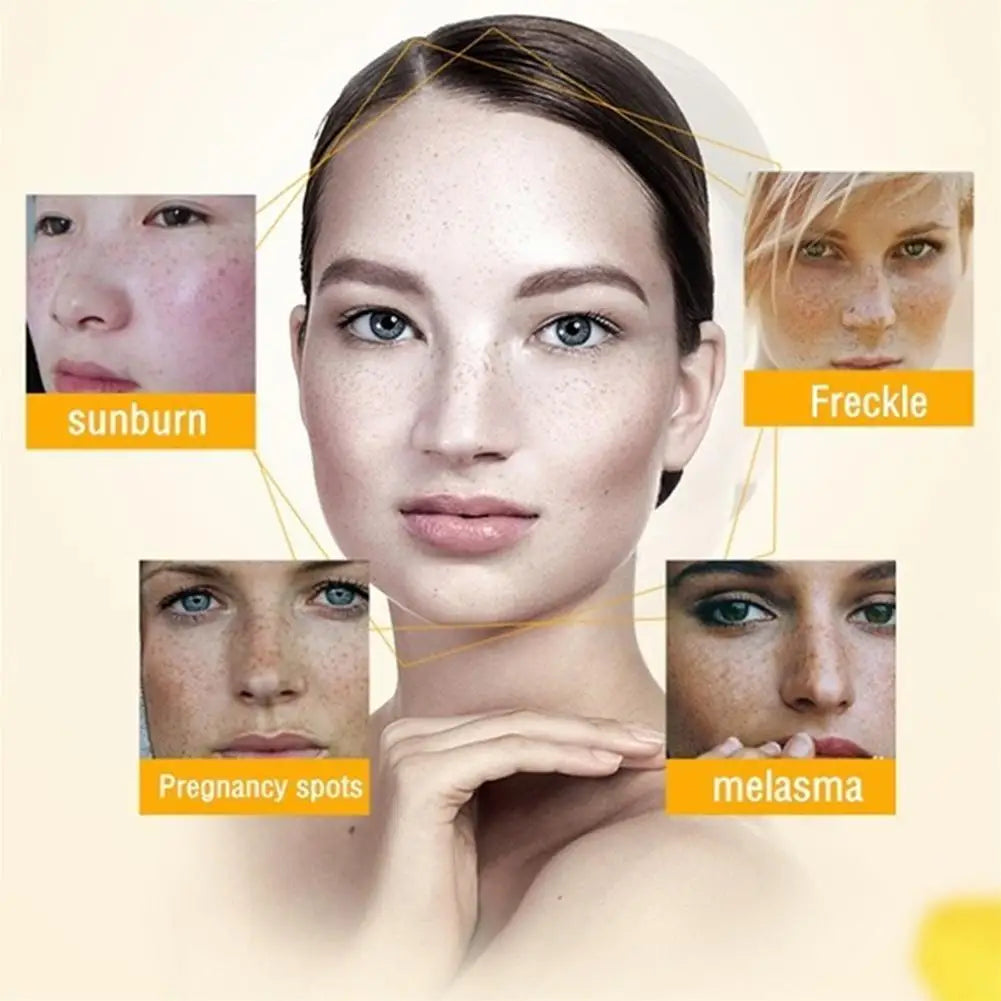 Whitening Freckle Cream Remove Dark Spots Anti Freckle Face Creams Niacinamide Fade Pigmentation Melasma Brighten Skin Care 20g